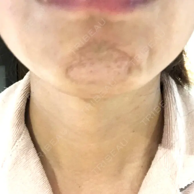 ボトックス（あご） フィラークリニック 横浜院 BEFORE メイン用