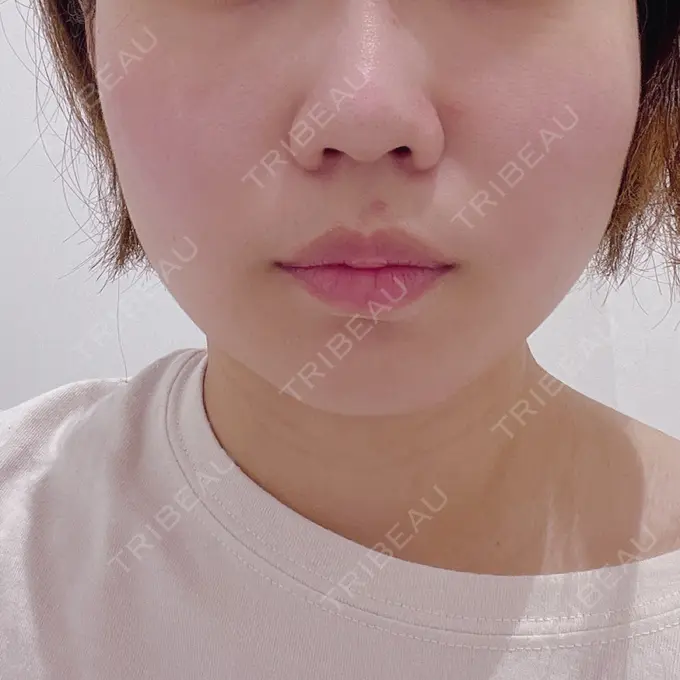 糸リフト / ボトックス（エラ・小顔） TCB東京中央美容外科 静岡院 BEFORE メイン用