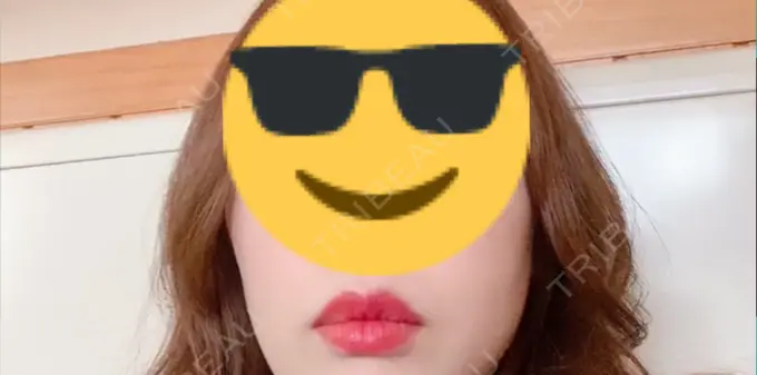 ヒアルロン酸注入（唇） / ボトックス（口角） id美容クリニック 銀座院 BEFORE メイン用