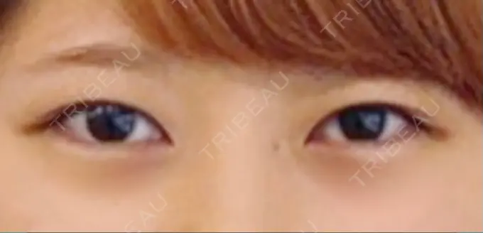 二重埋没 船橋中央クリニック BEFORE メイン用