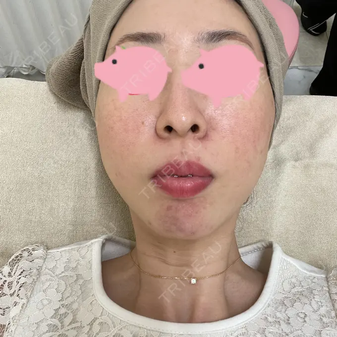 光治療（フォトフェイシャルなど） ゆめビューティークリニック BEFORE メイン用