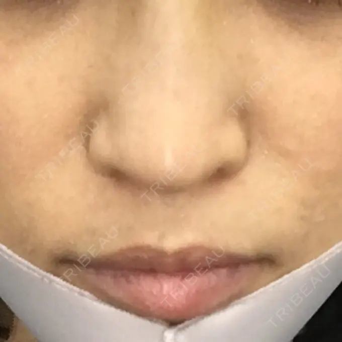 その他（輪郭） TCB東京中央美容外科 堺院 BEFORE メイン用