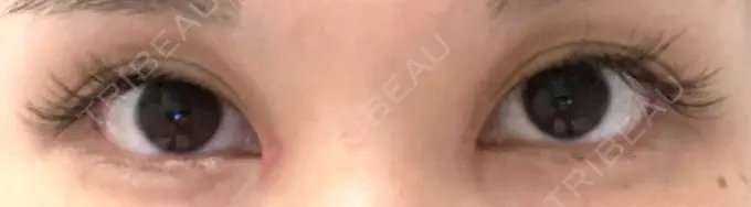 二重切開 / 蒙古ひだ形成 R.O.clinic BEFORE メイン用