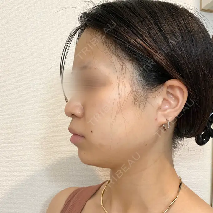 脂肪溶解注射（顔） 新宿美容外科クリニック 新宿院 BEFORE メイン用