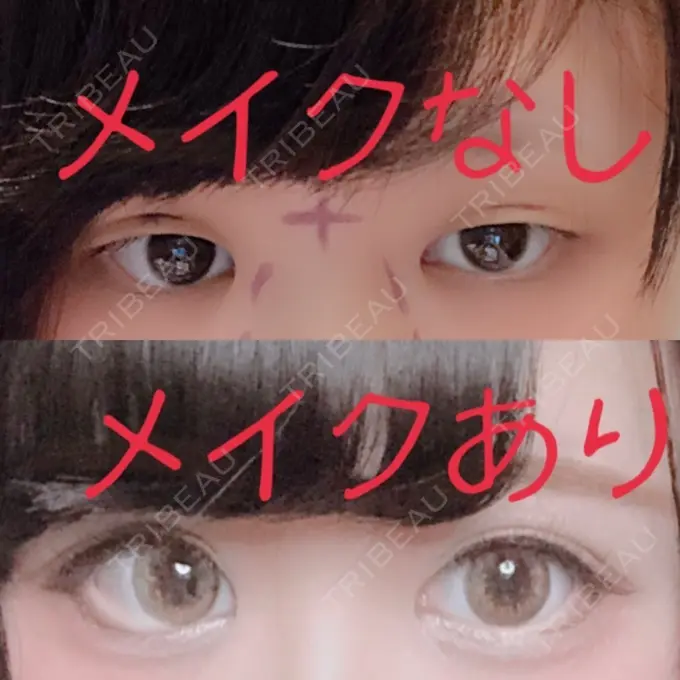 二重切開 / 目頭切開 / ヒアルロン酸注入（涙袋） FROM B整形外科 (旧バウム整形外科) BEFORE メイン用