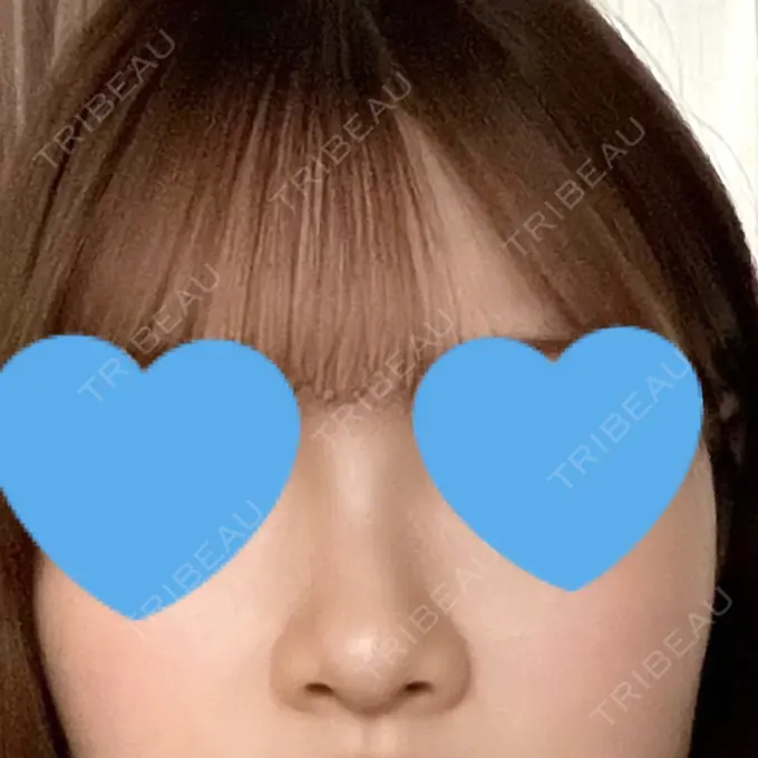 ヒアルロン酸注入（鼻） プライベートスキンクリニック 梅田本院 BEFORE メイン用