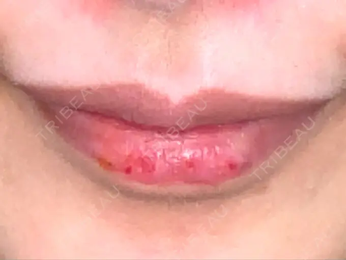 ヒアルロン酸注入（唇） / ボトックス（口角） id美容クリニック 銀座院 BEFORE メイン用