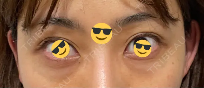 二重埋没 / クマ治療 / 上まぶたたるみ取り / 下まぶたたるみ取り MIL CLINIC OSAKA BEFORE メイン用