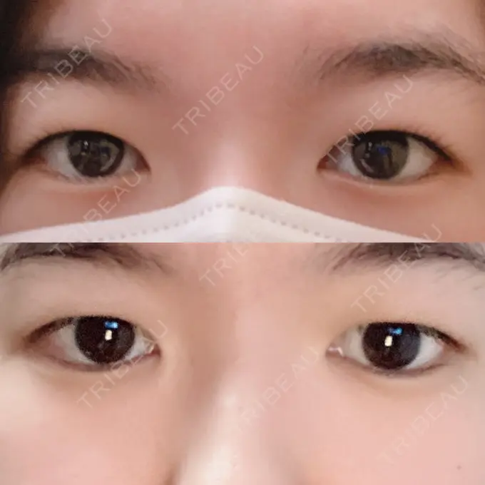 二重埋没 札幌ル・トロワ ビューティクリニックVogue BEFORE メイン用