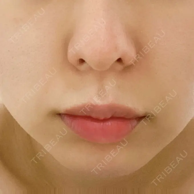 ハイフ（顔） TCB東京中央美容外科 柏院 BEFORE メイン用