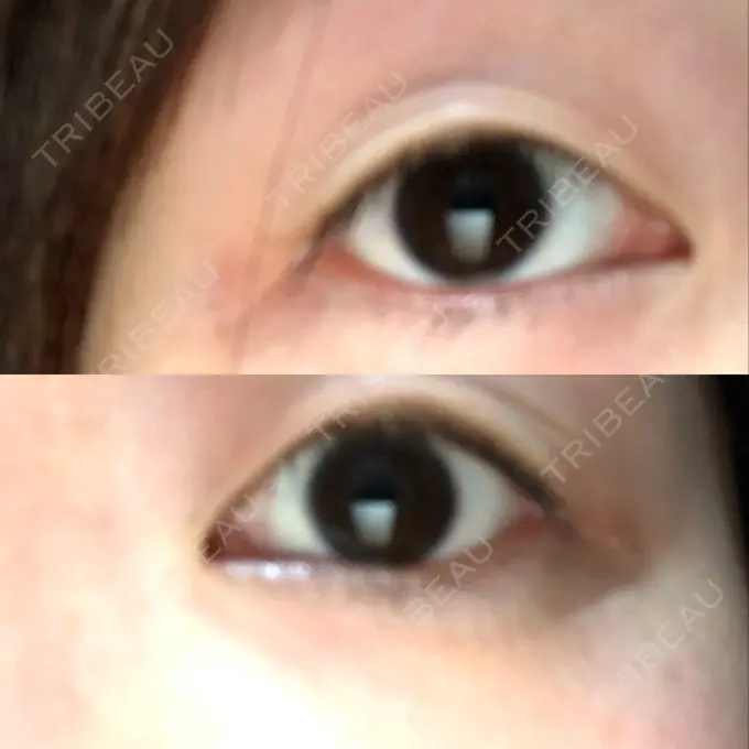 二重埋没 湘南美容クリニック 長野院 BEFORE メイン用