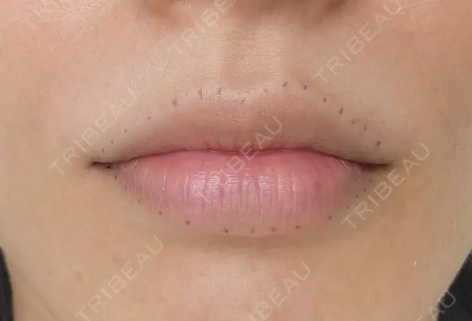 アートメイク（唇） エイトビューティークリニック 新宿院 BEFORE メイン用