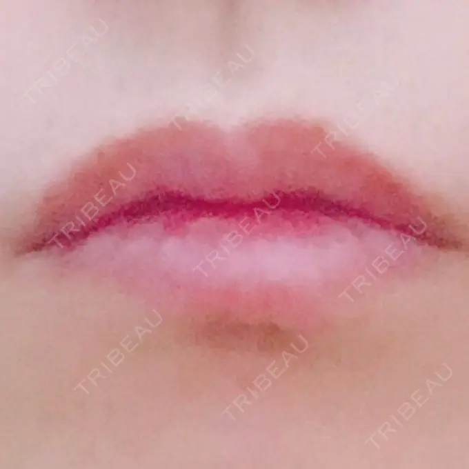 口角挙上 宇都宮竹内クリニック BEFORE メイン用