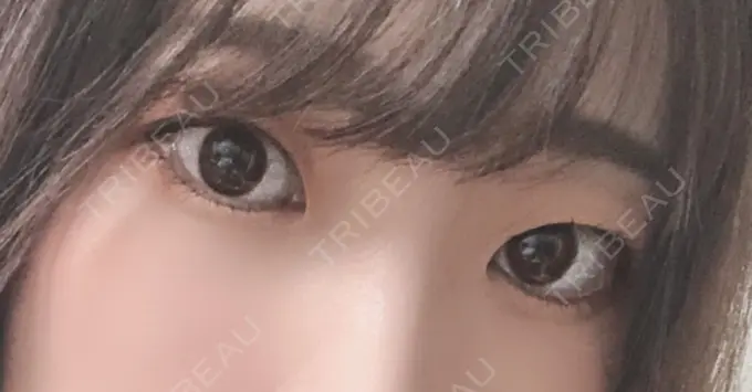 ヒアルロン酸注入（涙袋） フィラークリニック 横浜院 BEFORE メイン用