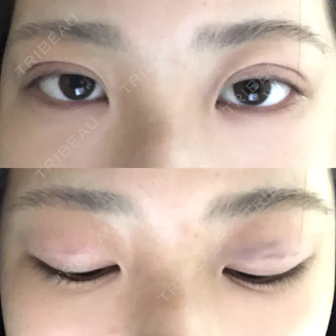 二重埋没 湘南メディカル記念病院（両国） BEFORE メイン用