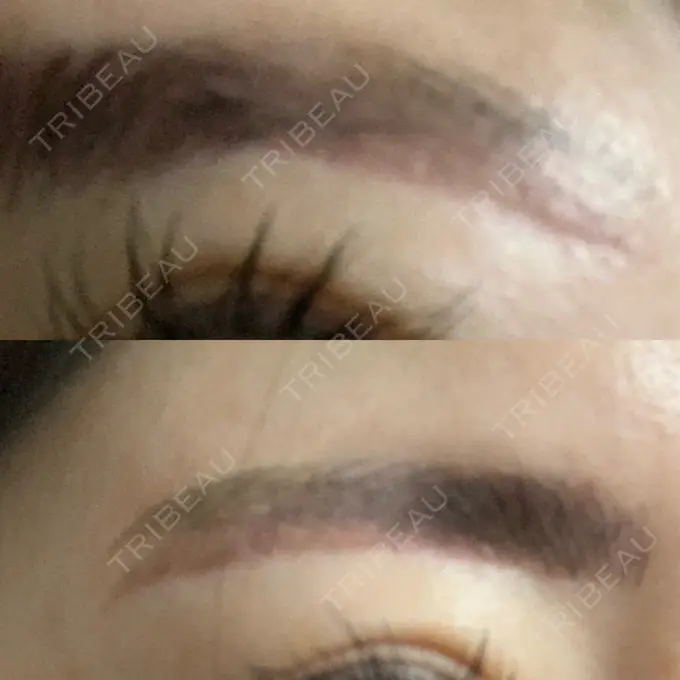その他（目元） / その他 / 傷跡修正 名古屋中央クリニック BEFORE メイン用
