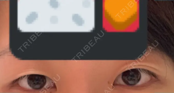 二重埋没 ハナビューティークリニック BEFORE メイン用