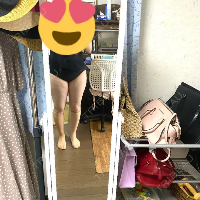 脂肪吸引（脚） THE CLINIC（ザ・クリニック） 名古屋院 BEFORE メイン用