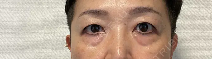 クマ治療 / 下まぶたたるみ取り セオリークリニック BEFORE メイン用