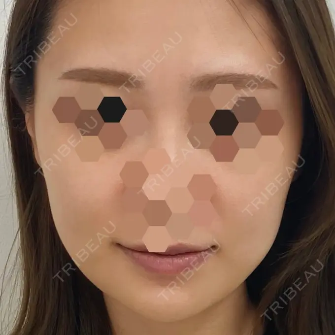 ハイフ（顔） STARS CLINIC BEFORE メイン用