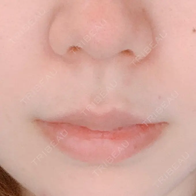 人中短縮 / ボトックス（口角） 新宿ラクル美容外科クリニック 新宿院 BEFORE メイン用