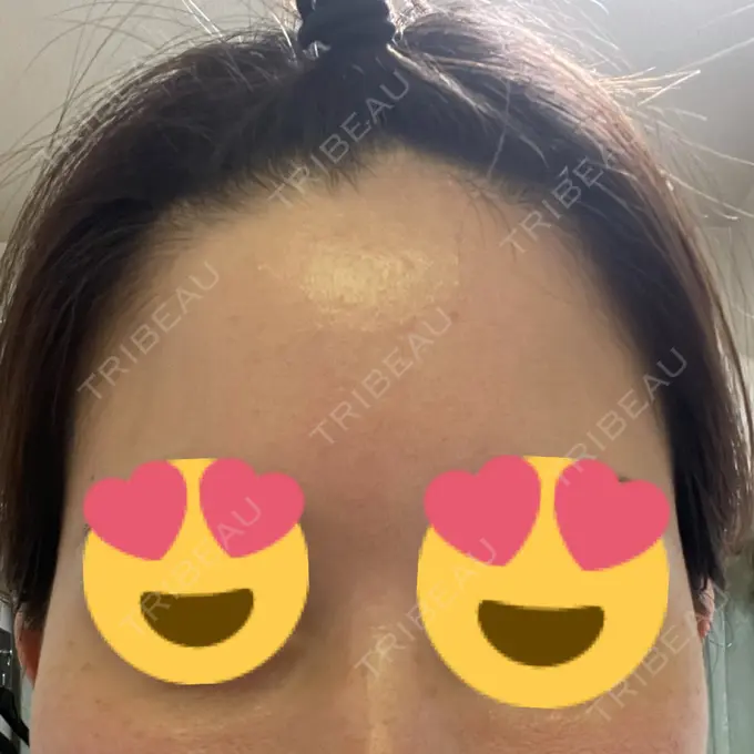 脂肪注入（額） / 脂肪注入（輪郭） 牧野美容クリニック BEFORE メイン用