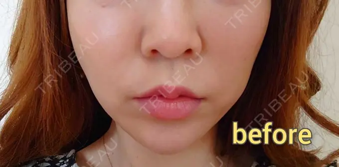 糸リフト MIL CLINIC OSAKA BEFORE メイン用