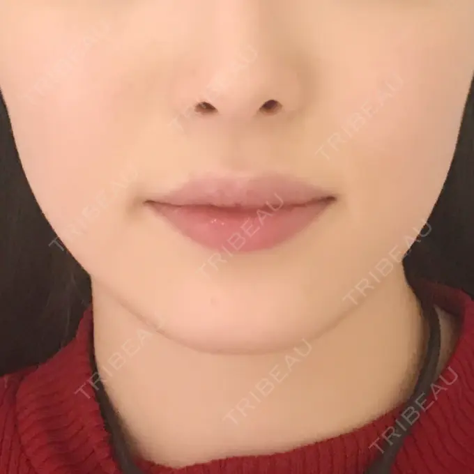 脂肪溶解注射（顔） S Beauty Clinic BEFORE メイン用