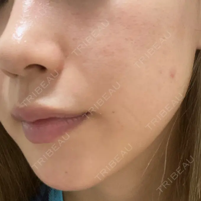 毛穴洗浄（ハイドラフェイシャルなど） X CLINIC 恵比寿院 BEFORE メイン用