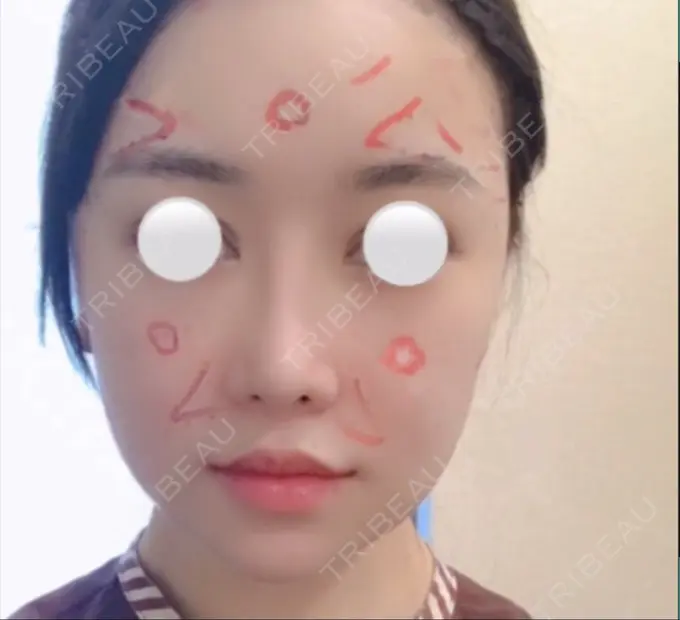 脂肪注入（額） / 脂肪注入（輪郭） スノウ（Snow）整形外科 BEFORE メイン用