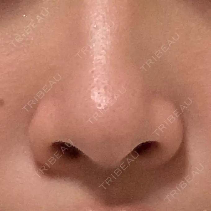 小鼻縮小（切開） / 鼻翼挙上 三輪皮フ科形成外科 BEFORE メイン用