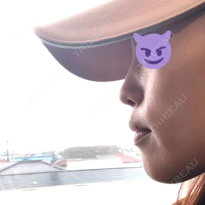 鼻中隔延長（切開） / 小鼻縮小（切開） みずほクリニック BEFORE メイン用