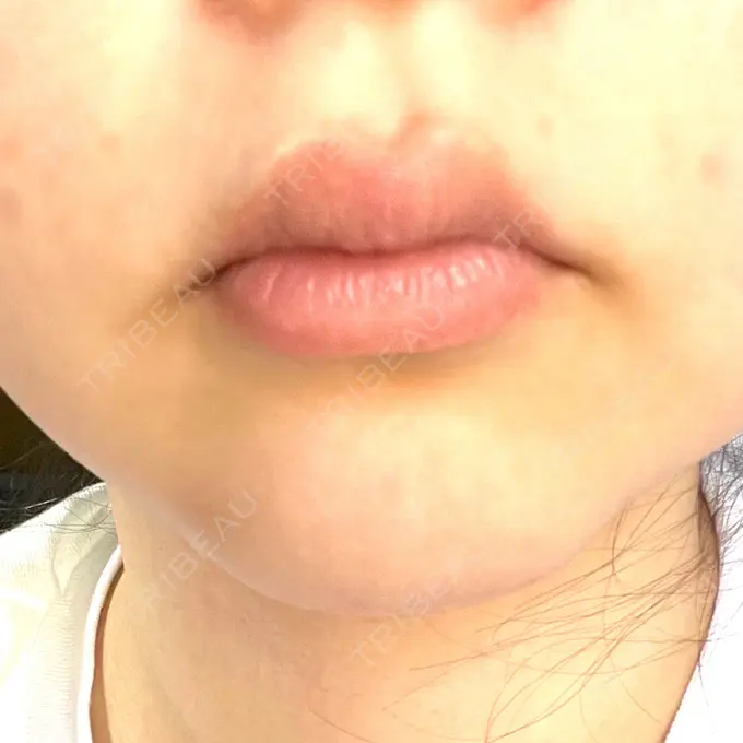 口角挙上 宇都宮竹内クリニック BEFORE メイン用