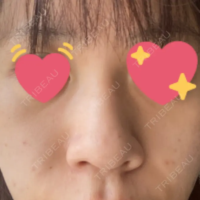 隆鼻術 / 鼻中隔延長（切開） みずほクリニック BEFORE メイン用