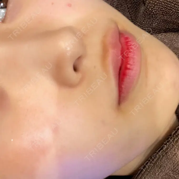 毛穴洗浄（ハイドラフェイシャルなど） AURORA CLINIC（オーロラクリニック）新宿院 BEFORE メイン用