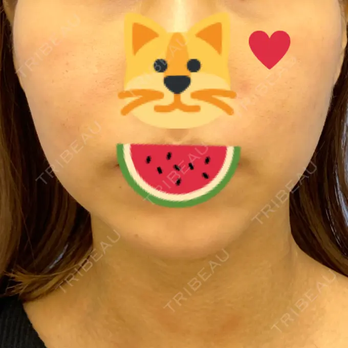 糸リフト / 脂肪吸引（顔） / メーラーファット除去 / 脂肪注入（輪郭） 湘南美容クリニック 秋葉原院 BEFORE メイン用