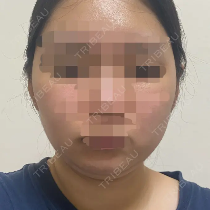 脂肪吸引（顔） THE CLINIC（ザ・クリニック） 福岡院 BEFORE メイン用