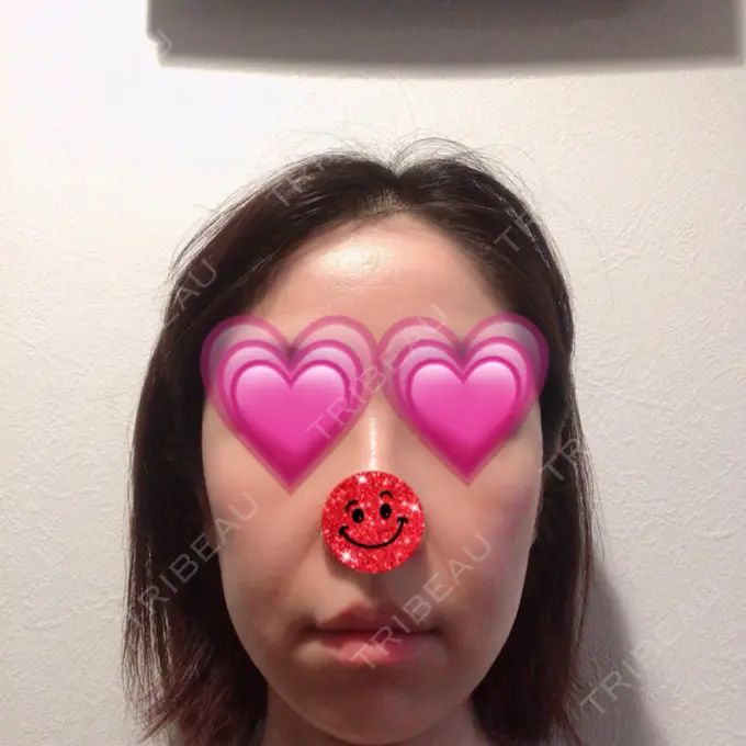 糸リフト / バッカルファット除去 / 脂肪吸引（顔） / メーラーファット除去 / ジョールファット除去 / ボトックス（エラ・小顔） / その他（輪郭） 湘南美容クリニック 秋葉原院 BEFORE メイン用