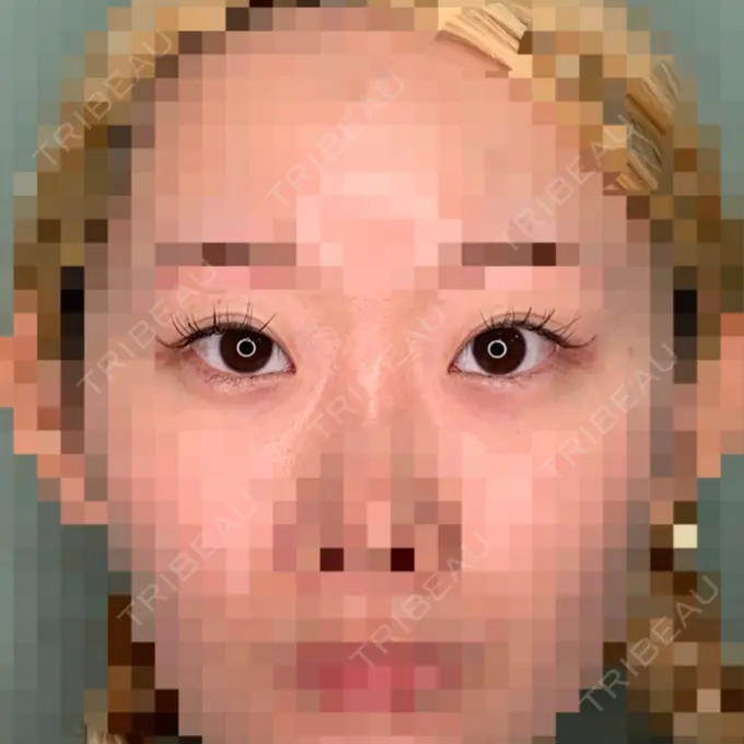 目頭切開 / 目尻切開 くさのたろうクリニック BEFORE メイン用