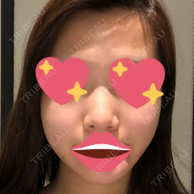 隆鼻術 / 鼻尖形成（切開） / 鼻中隔延長（切開） / 小鼻縮小（切開） / 軟骨移植 / 骨切幅寄せ id（アイディ）美容外科 BEFORE メイン用