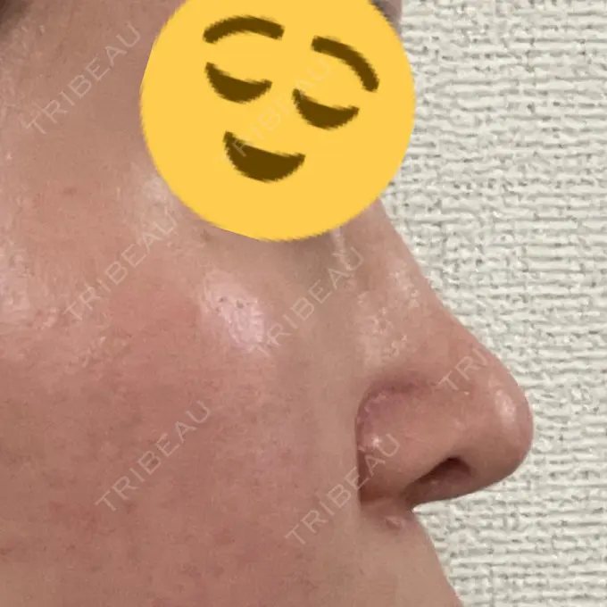 鼻修正 / 鼻孔縁下降 牧野美容クリニック BEFORE メイン用