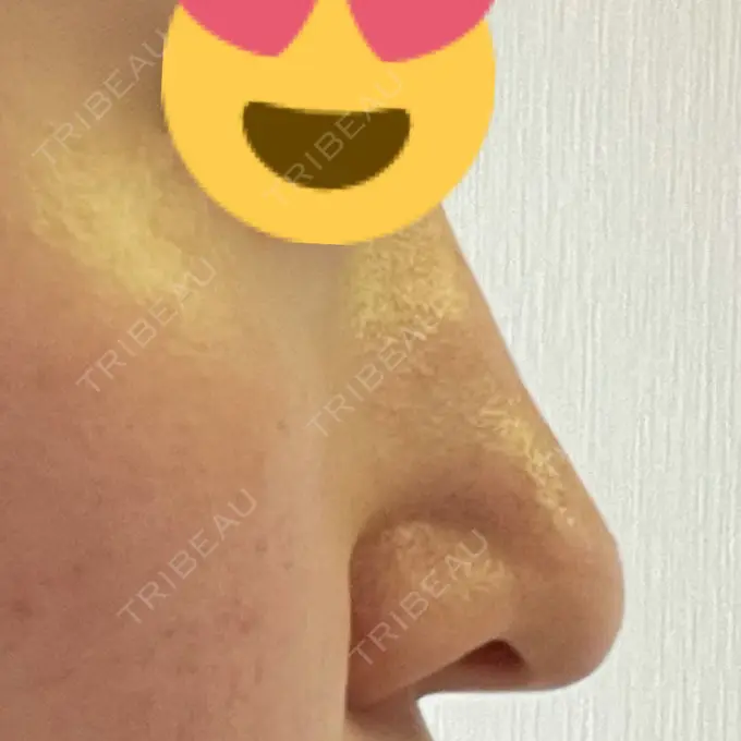 鼻中隔延長（切開） / 小鼻縮小（切開） / 軟骨移植 牧野美容クリニック BEFORE メイン用