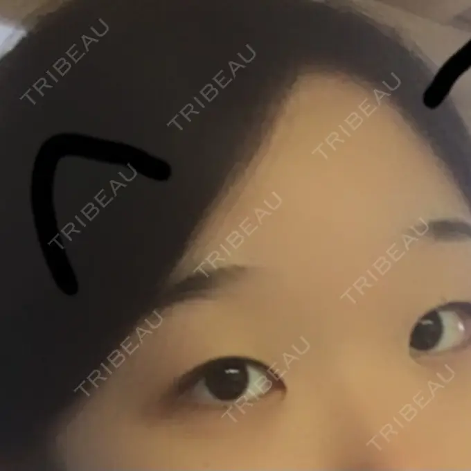 二重切開 / 目頭切開 / 眼瞼下垂（切開） / その他（目元） ブリスクリニック形成外科・美容外科・美容皮膚科 福岡 BEFORE メイン用