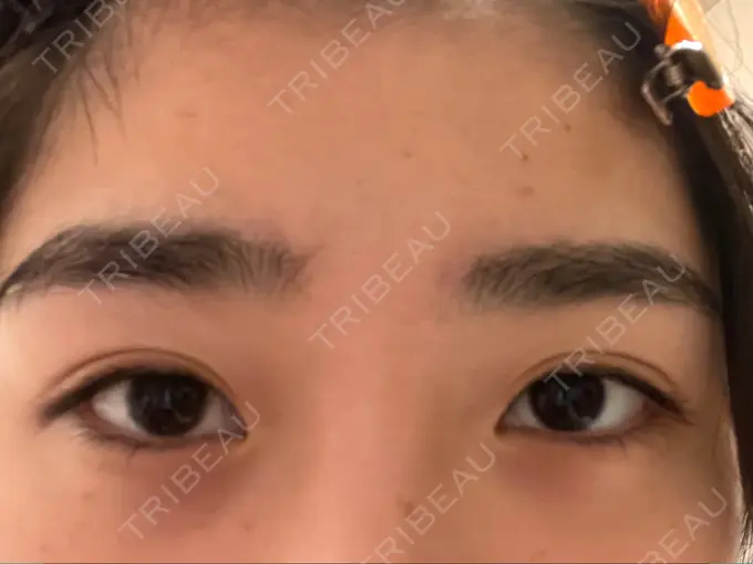 二重切開 高須クリニック 横浜院 BEFORE メイン用