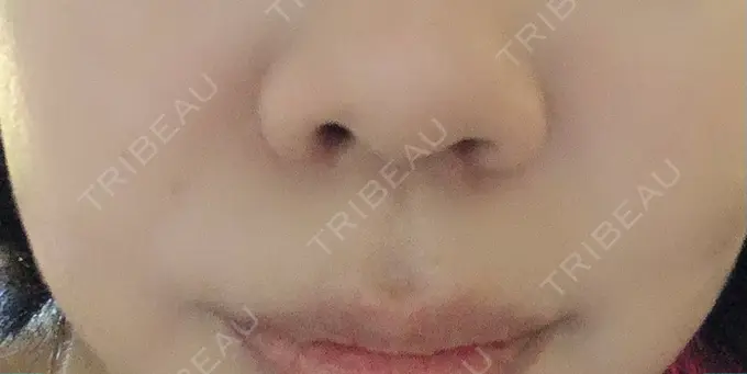 鼻尖形成（切開） / 軟骨移植 / その他（鼻） ジョウクリニック 那覇院 BEFORE メイン用