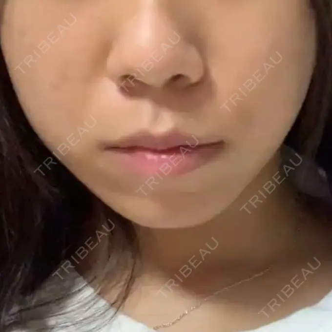 肌ヒアルロン酸注入（たるみ・シワ改善） / ボトックス（エラ・小顔） / その他（鼻） YBC横浜美容外科 大宮院 BEFORE メイン用