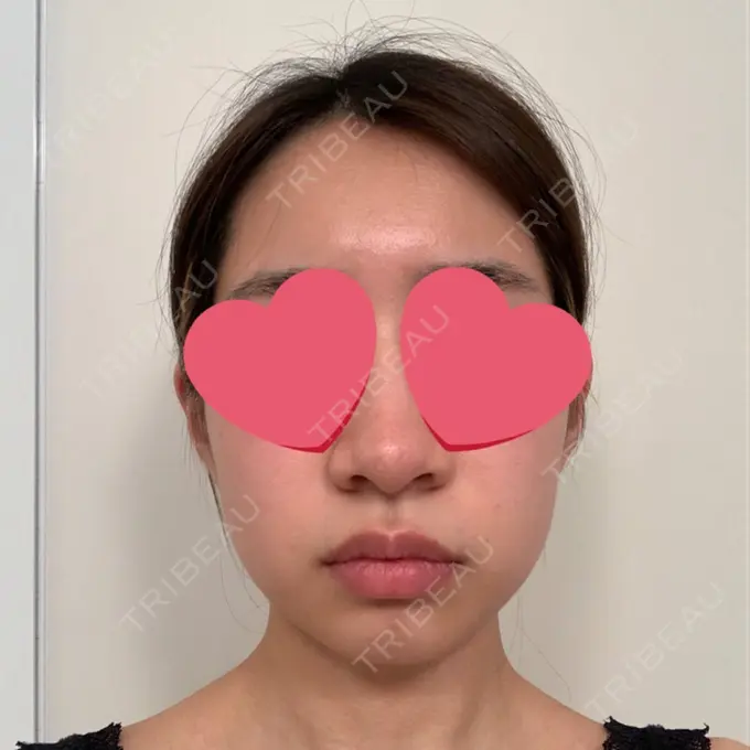 糸リフト / 脂肪吸引（顔） / メーラーファット除去 / ジョールファット除去 / ヒアルロン酸注入（頬） SEA CLINIC（シークリニック） BEFORE メイン用