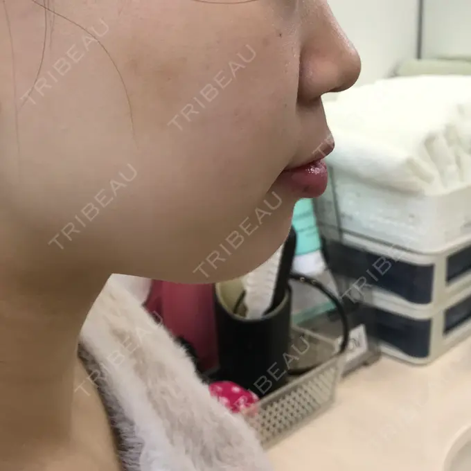 あごプロテーゼ 北尾クリニック BEFORE メイン用