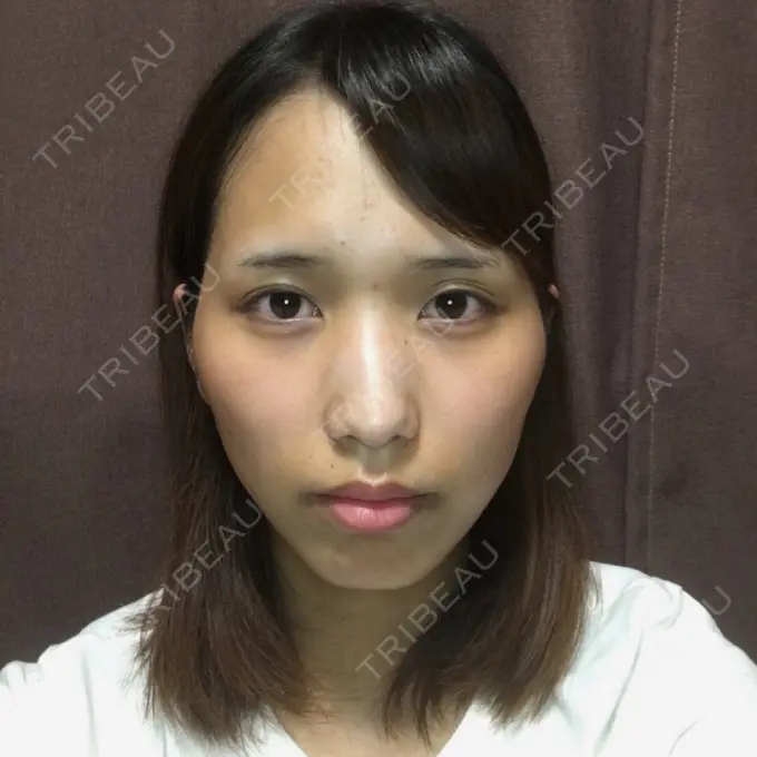 二重埋没 / 骨切り（あご） / 骨削り（頬） / 軟骨移植 / 骨切幅寄せ バノバギ整形外科 BEFORE メイン用