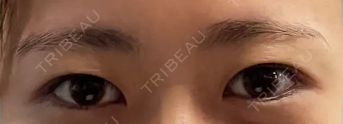 二重埋没 湘南メディカル記念病院（両国） BEFORE メイン用